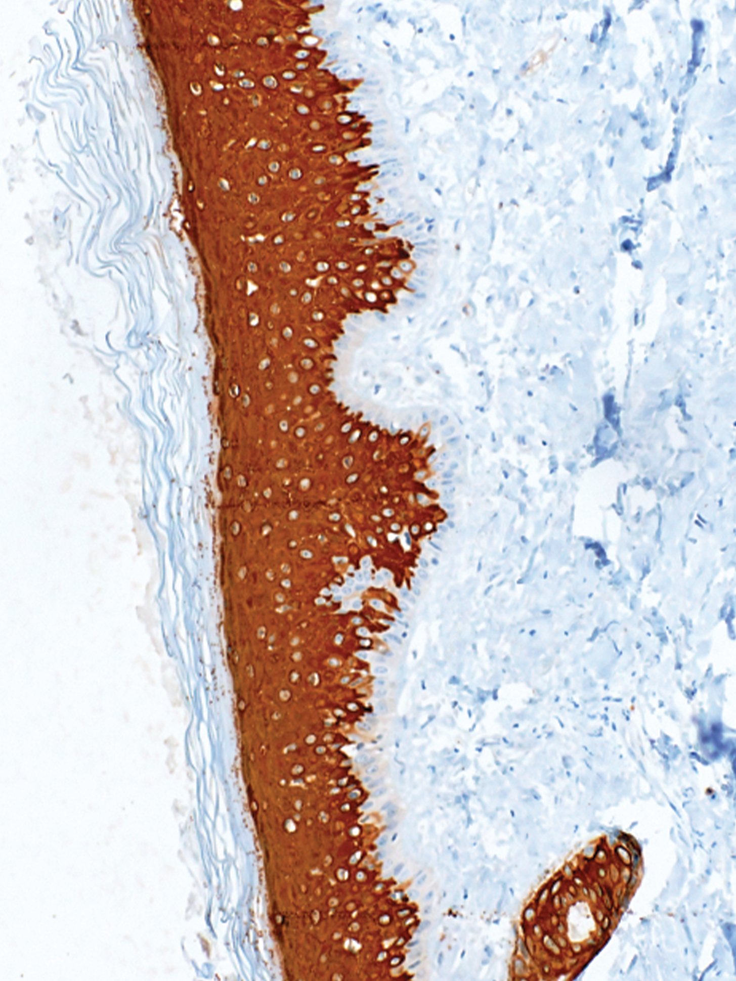 Cytokeratin 10