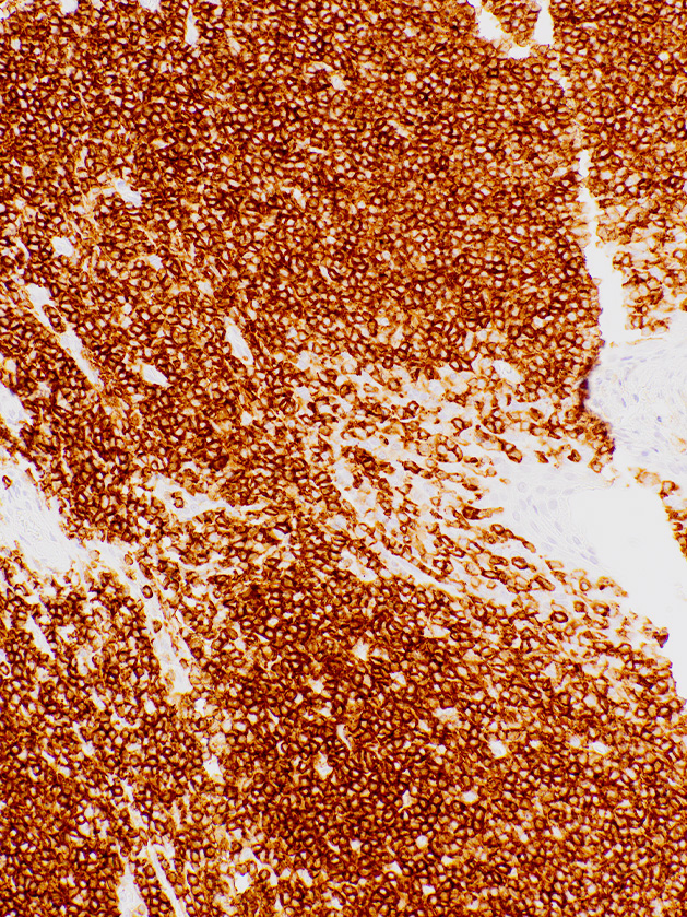 CD45 (LCA)