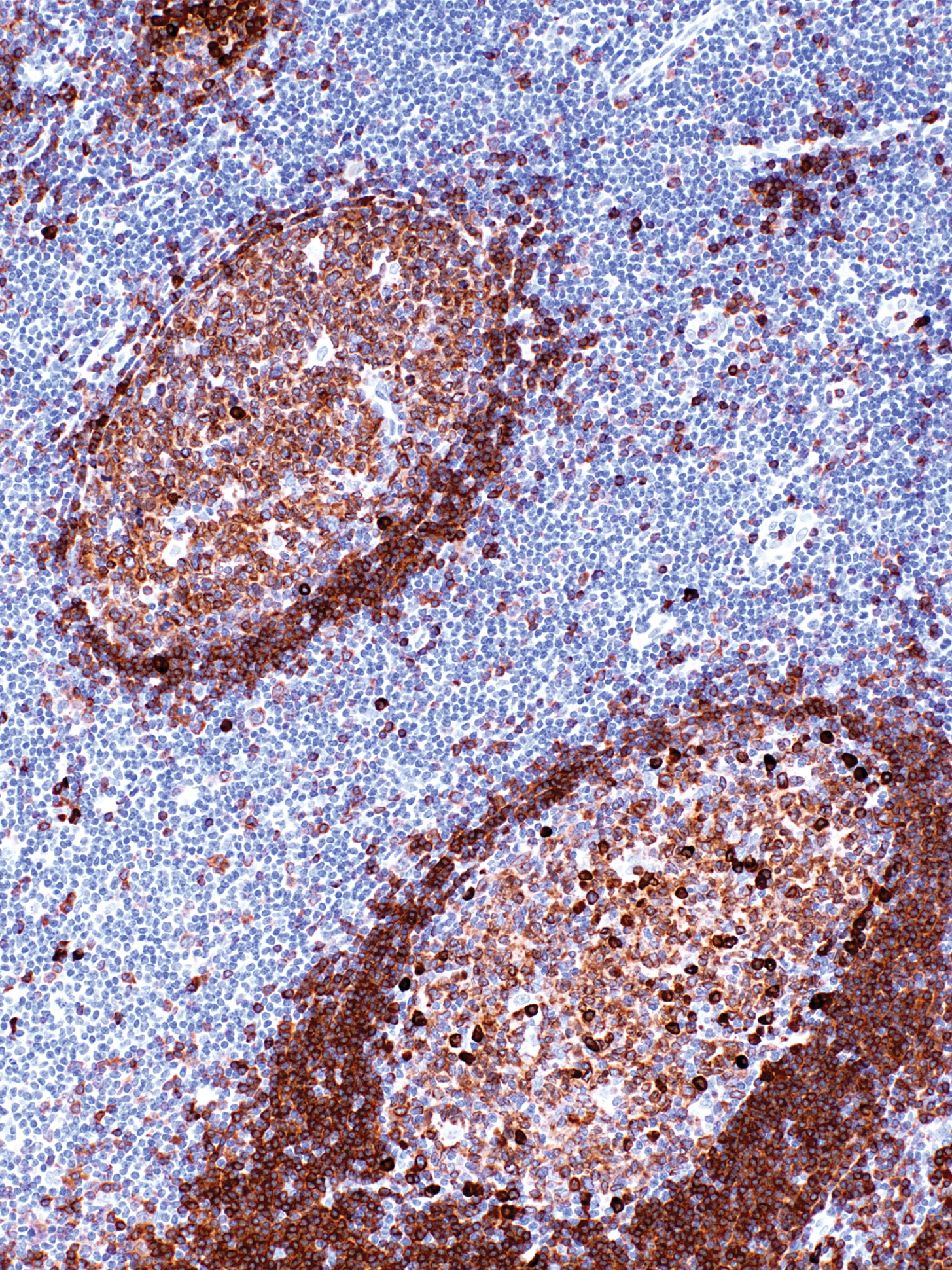 CD79a