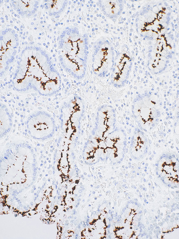 Helicobacter pylori