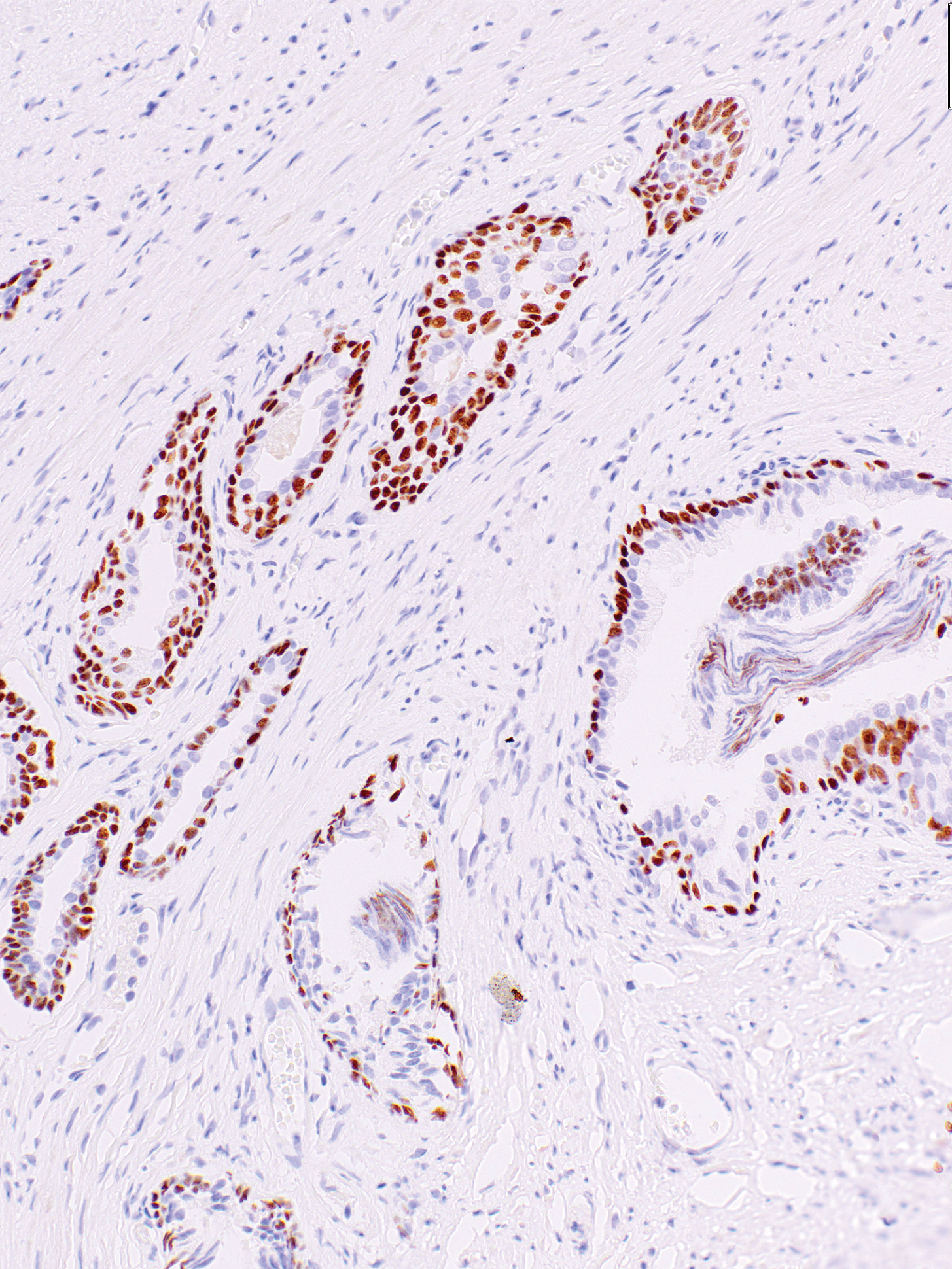 Androgen Receptor