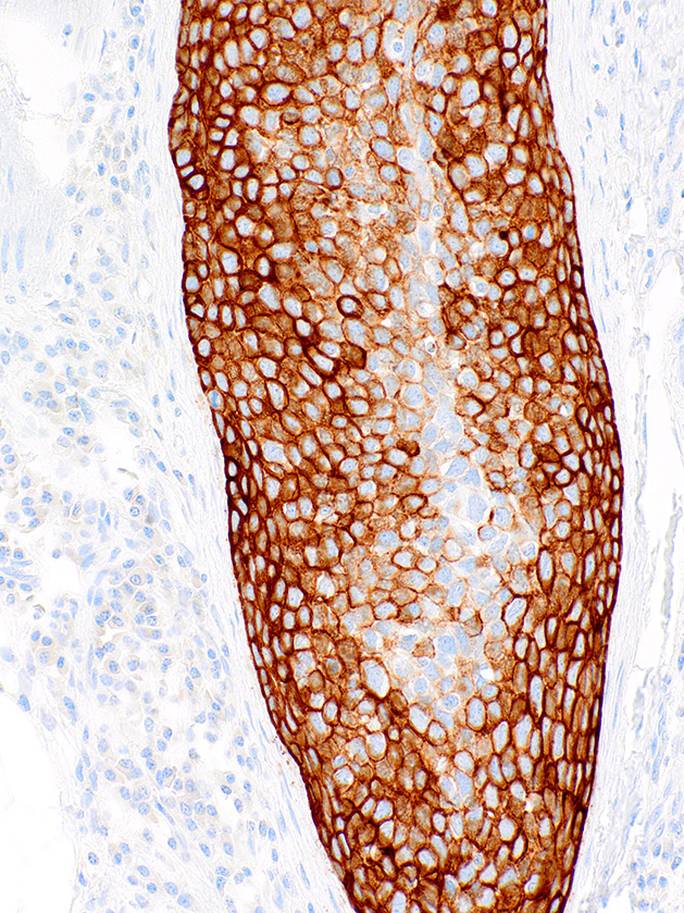 Cytokeratin 5/6