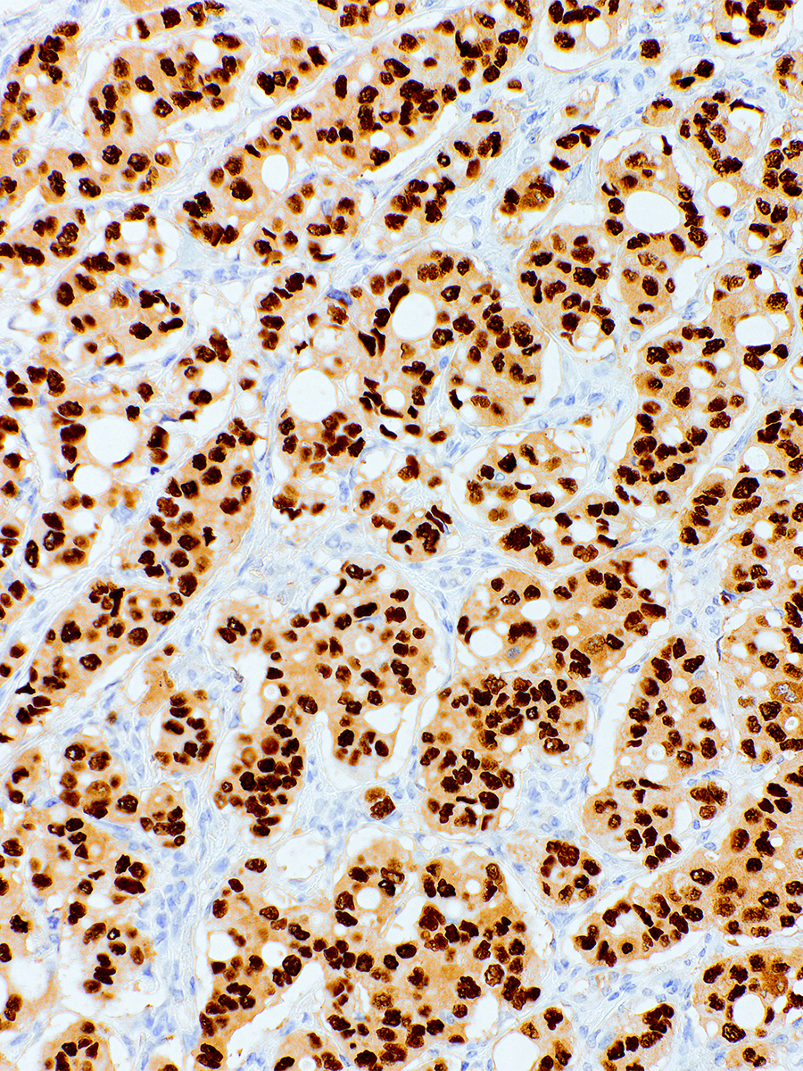 Progesterone Receptor